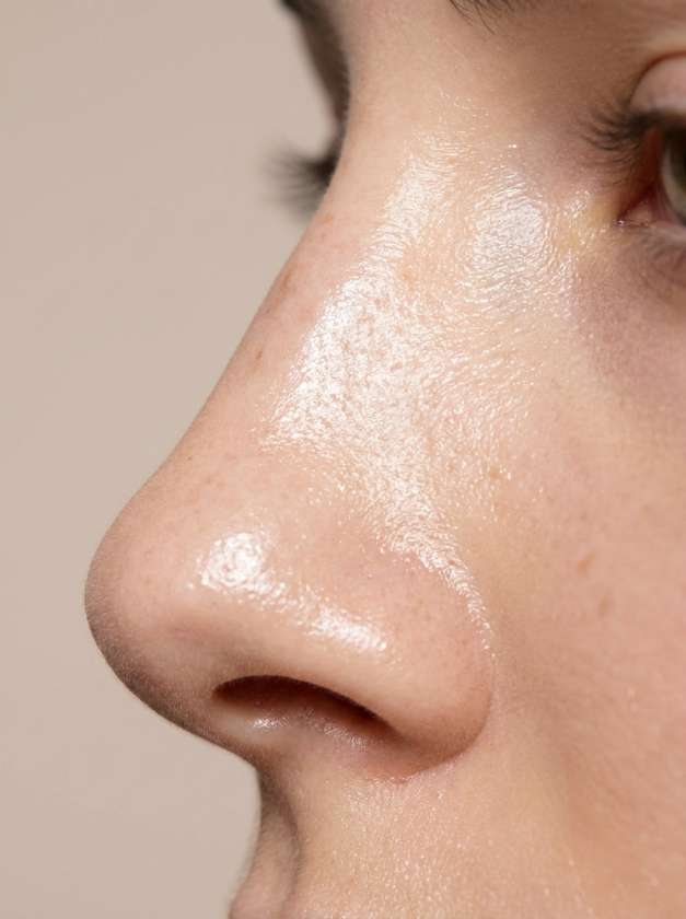 Rhinoplasty