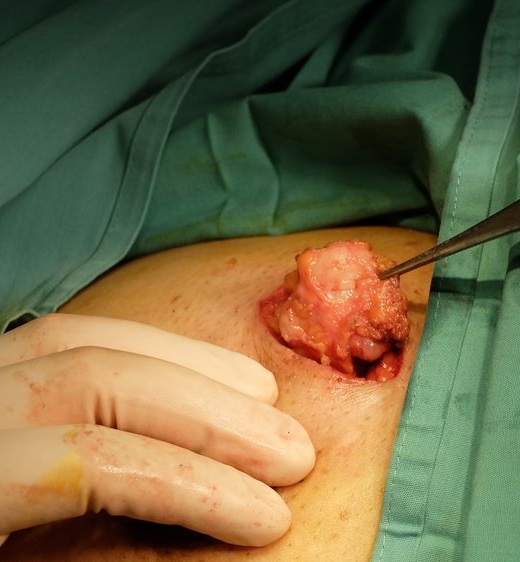 fibroadenoma-surgery-in-pimpri